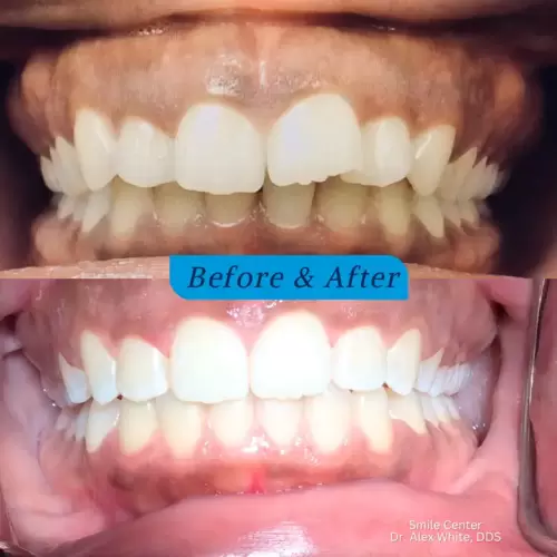 fastbraces_before___after